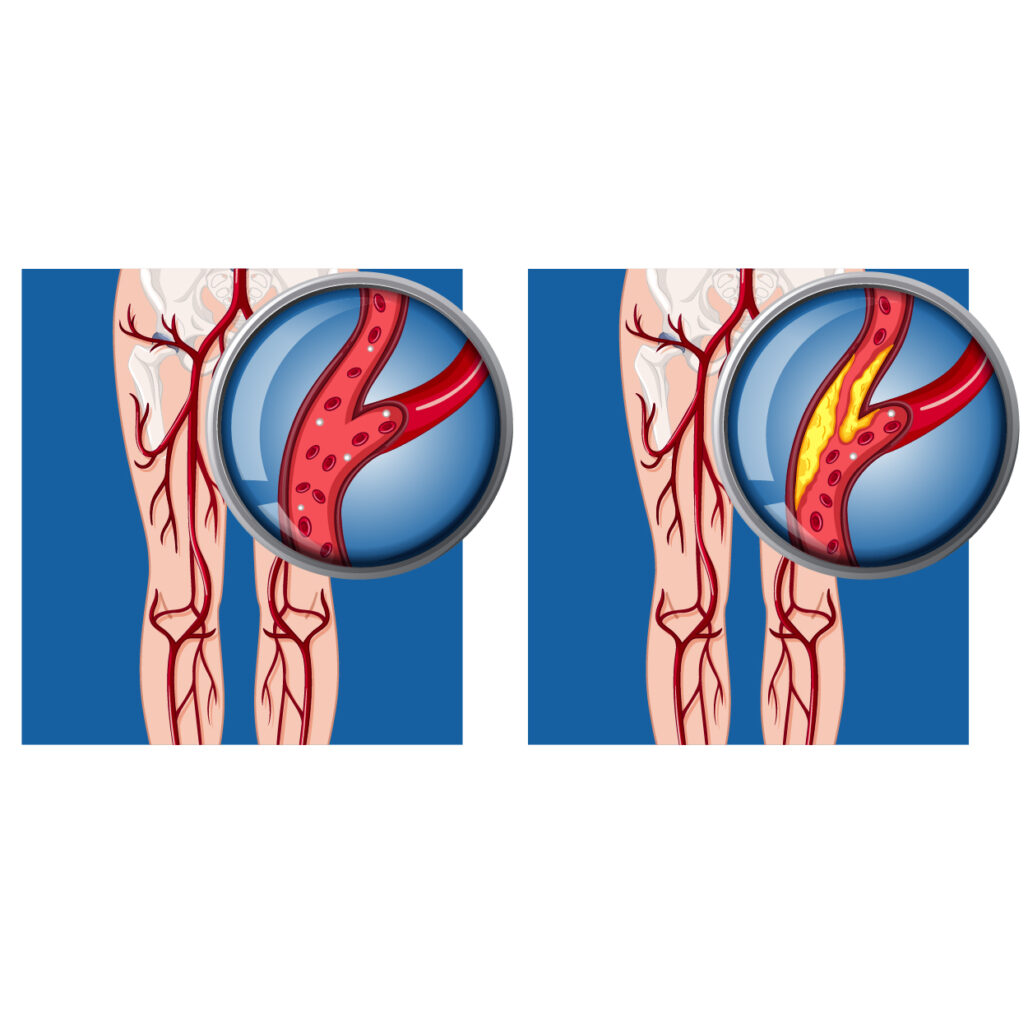 Peripheral Arterial Disease